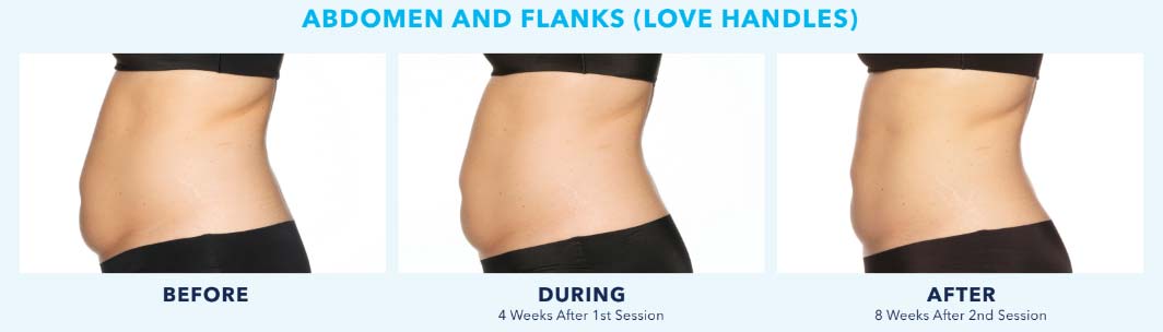 Coolsculpting Results