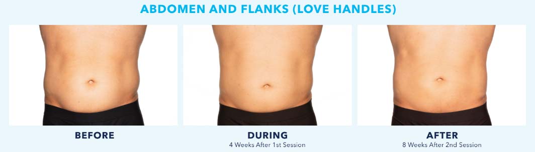 Coolsculpting Results