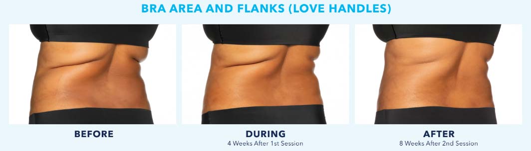 Coolsculpting Results