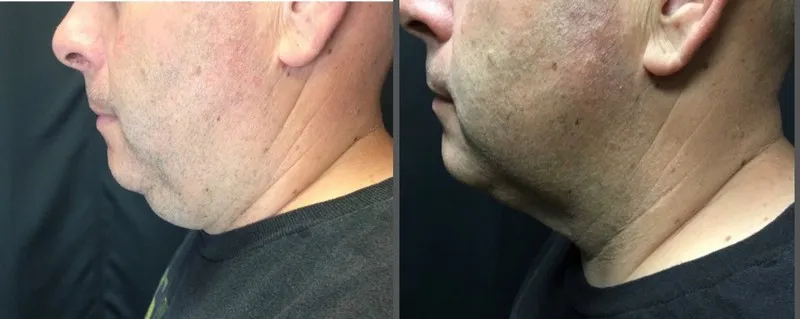 Coolsculpting Results