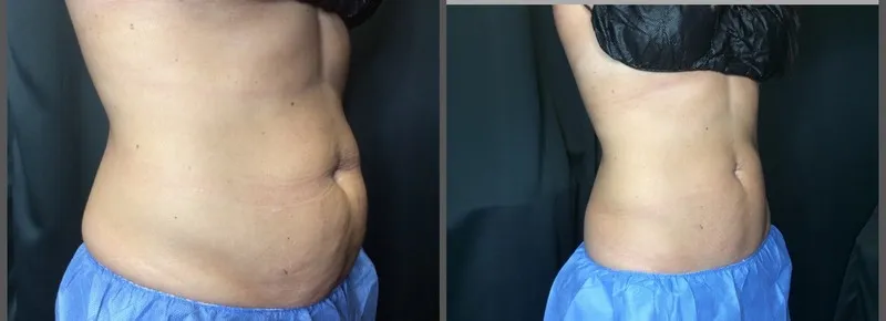 Coolsculpting Results