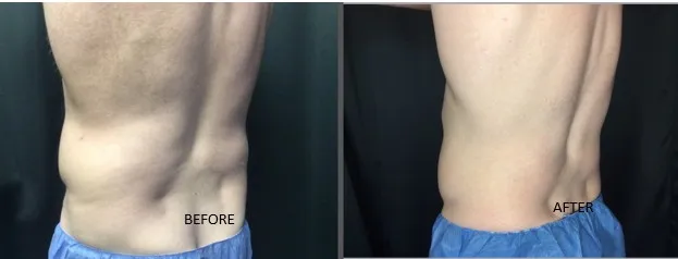 Coolsculpting Results