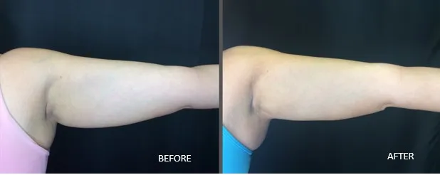 Coolsculpting Results