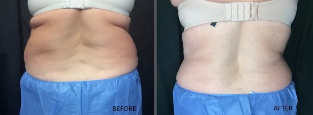 Coolsculpting Results