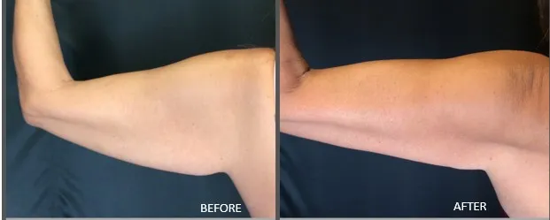Coolsculpting Results