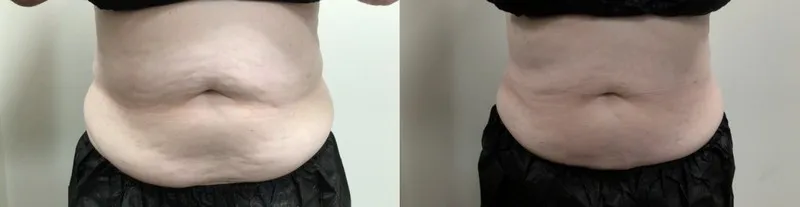 Coolsculpting Results