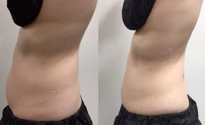 Coolsculpting Results