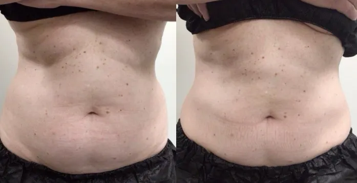 Coolsculpting Results
